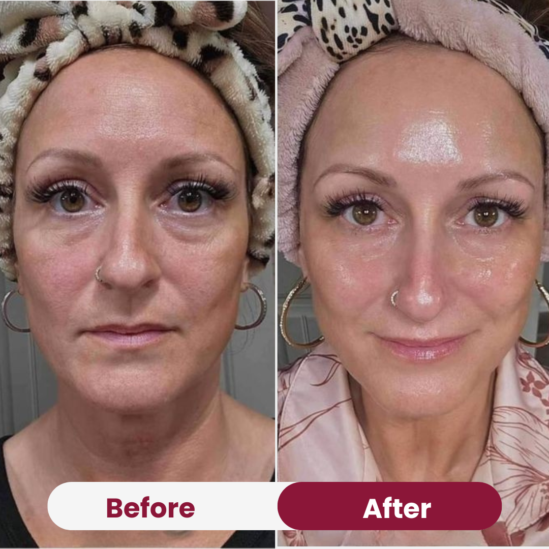 GlanzMaske™ Jugendliche Haut Maske