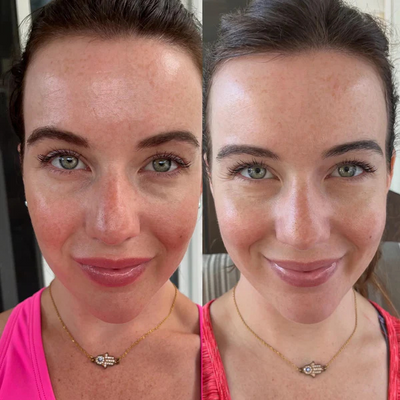 LumiGlow™ - Schmerzfreie Behandlung: Nicht-invasive Therapie